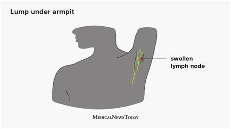 photos of armpit lumps|axillary lymph nodes swollen images.